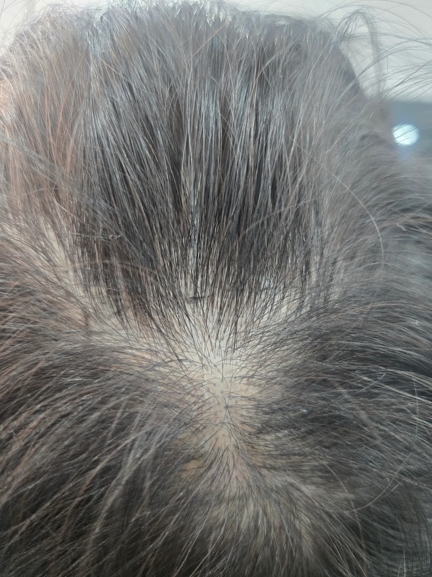 Scalp Micropigmentation — Before