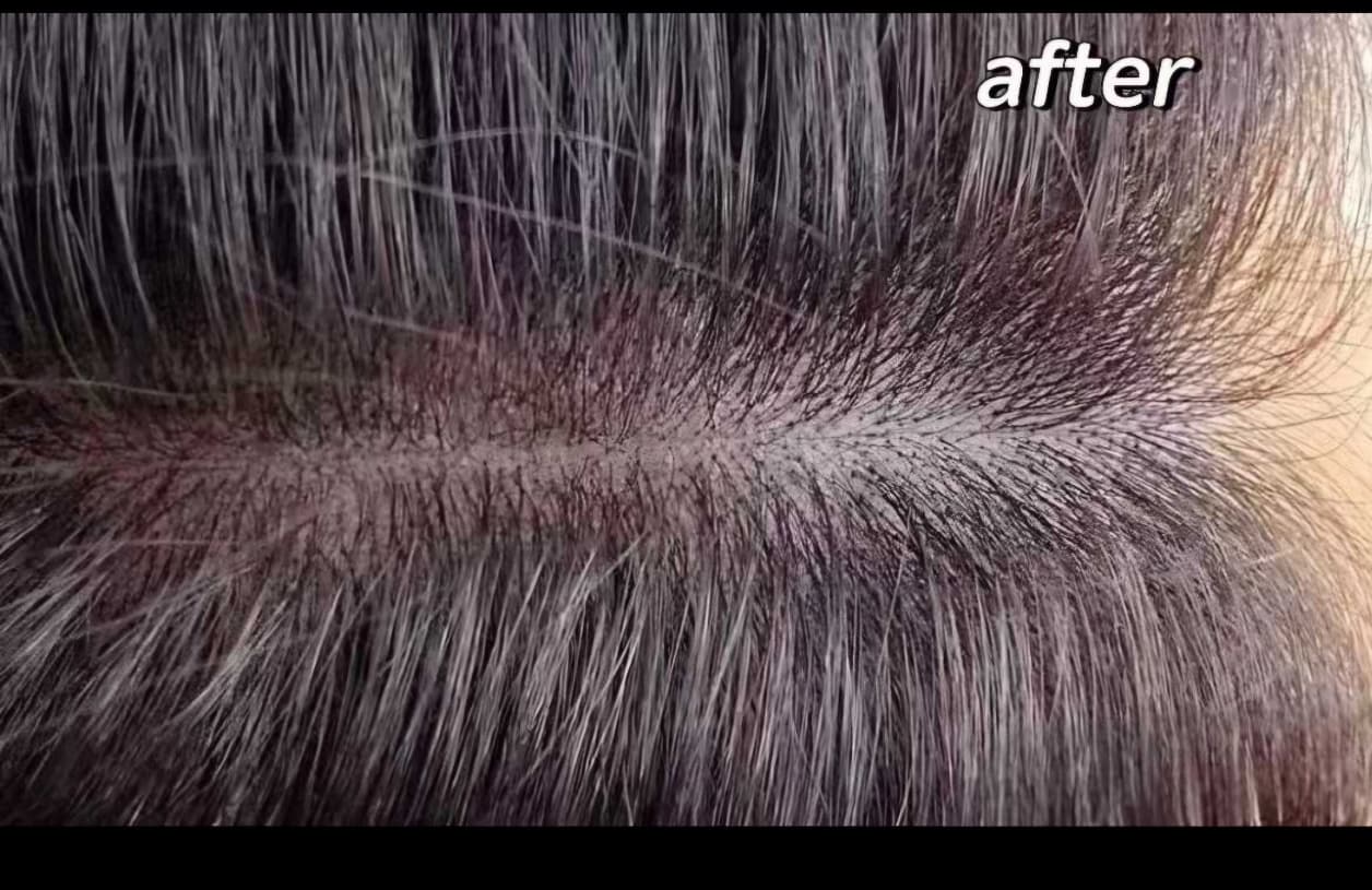 Scalp Micropigmentation — After